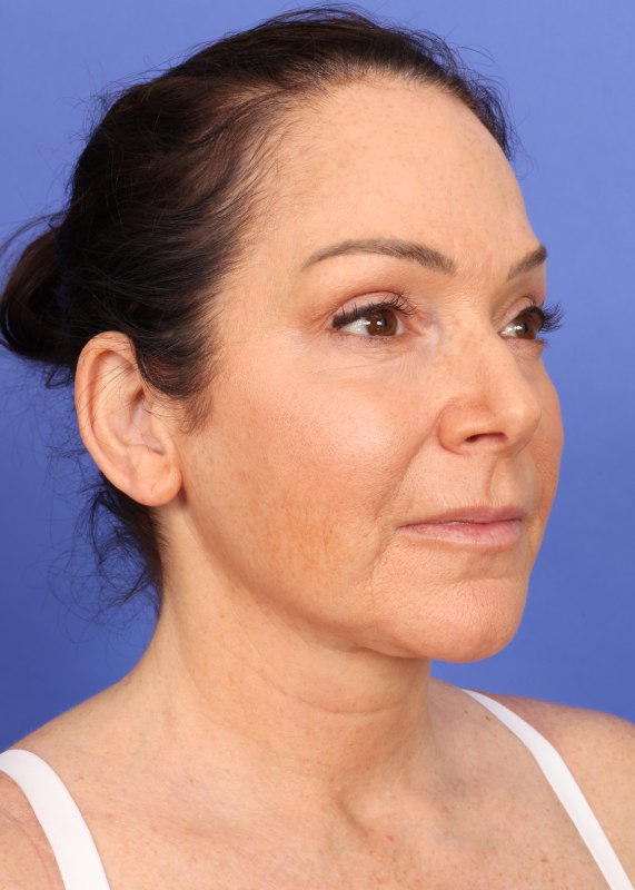 MyEllevate Neck Lift Before & After Image