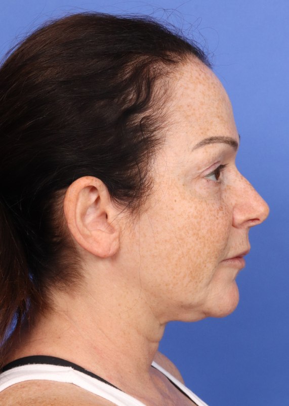 MyEllevate Neck Lift Before & After Image