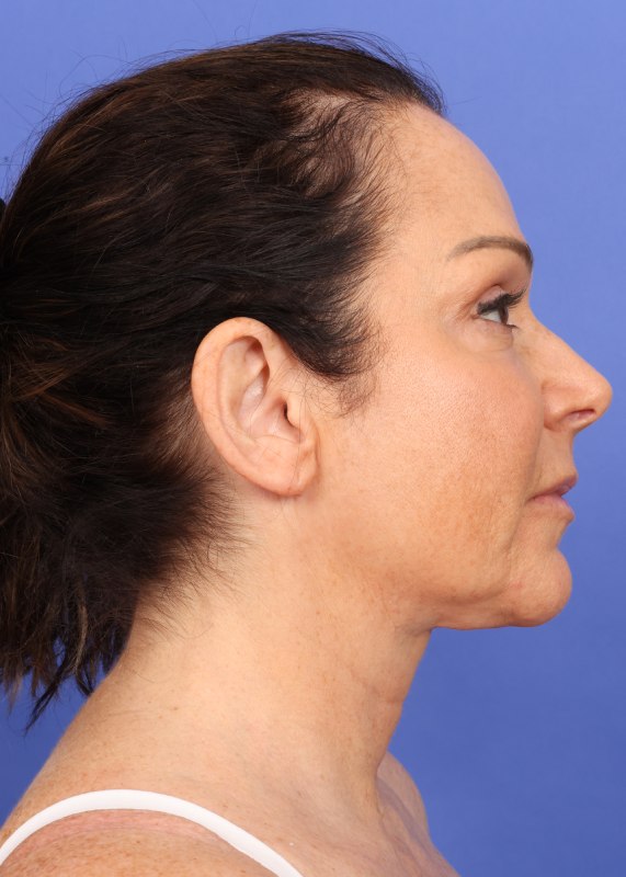 MyEllevate Neck Lift Before & After Image