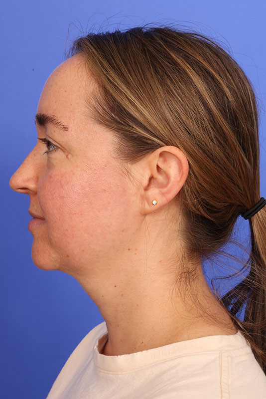 MyEllevate Neck Lift Before & After Image
