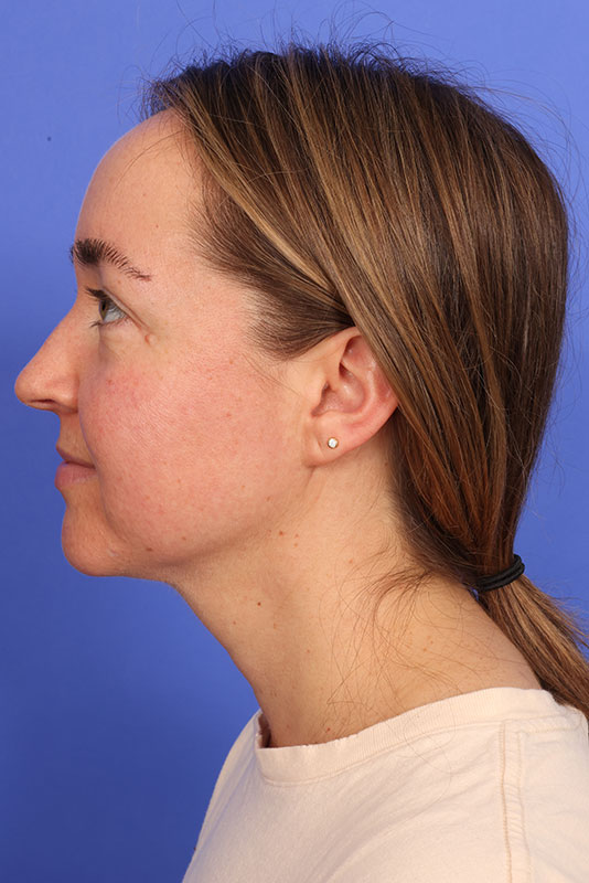 MyEllevate Neck Lift Before & After Image