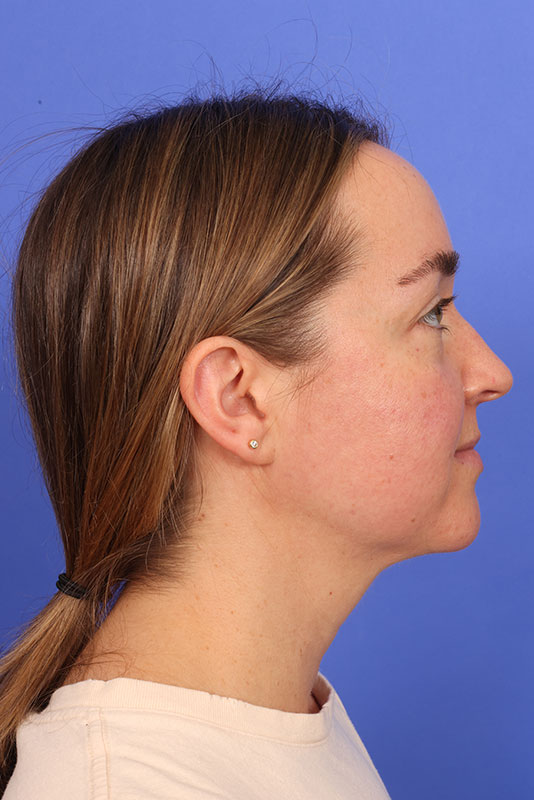 MyEllevate Neck Lift Before & After Image