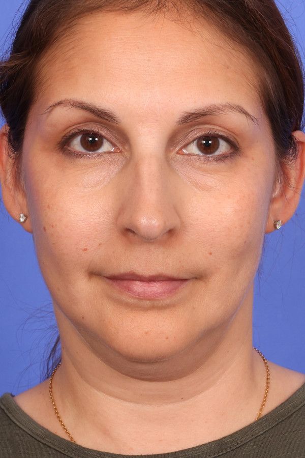 Ellevate neck lift Before & After Image