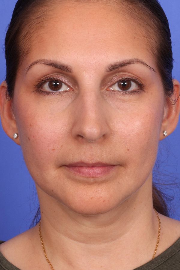 Ellevate neck lift Before & After Image