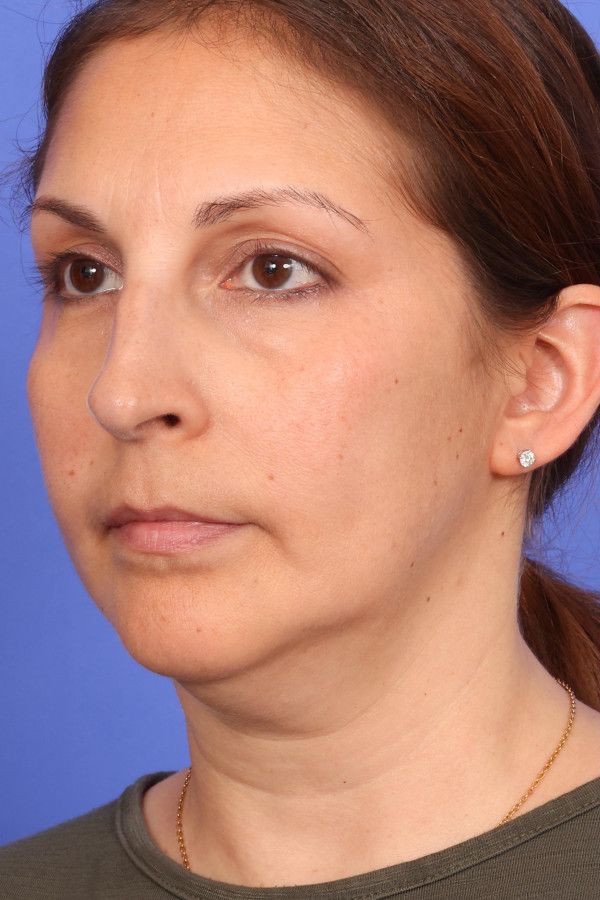 Ellevate neck lift Before & After Image