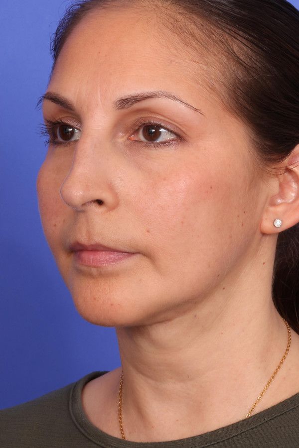 Ellevate neck lift Before & After Image