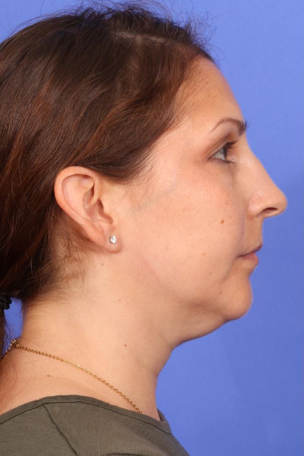 MyEllevate Neck Lift Before & After Image