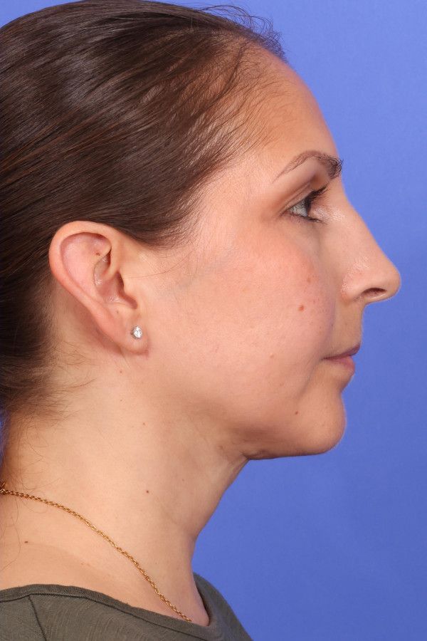 MyEllevate Neck Lift Before & After Image