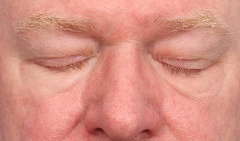 Eyelid Surgery Before & After Image