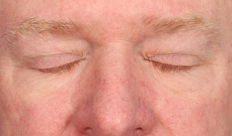 Eyelid Surgery Before & After Image