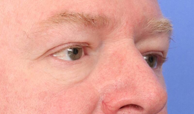 Eyelid Surgery Before & After Image