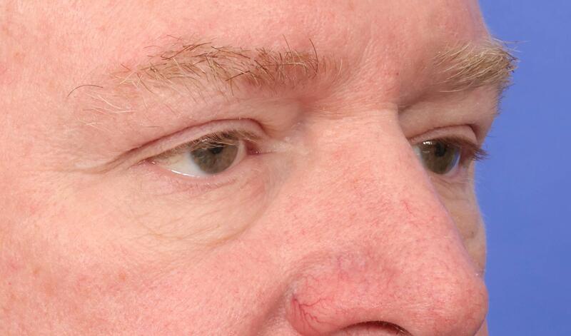 Eyelid Surgery Before & After Image