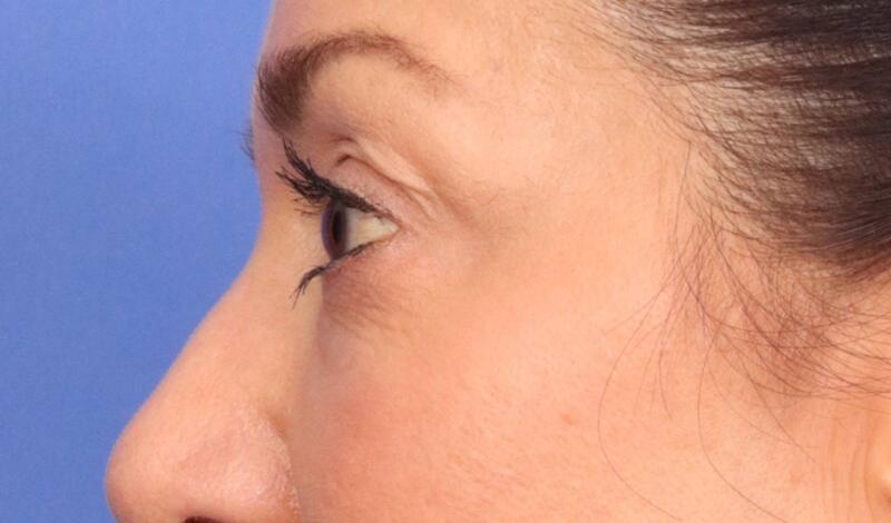 Eyelid Surgery Before & After Image