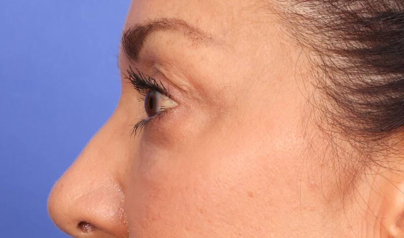 Eyelid Surgery Before & After Image