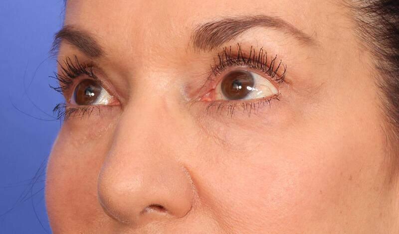 Eyelid Surgery Before & After Image