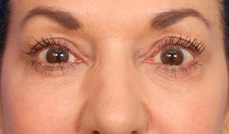 Eyelid Surgery Before & After Image