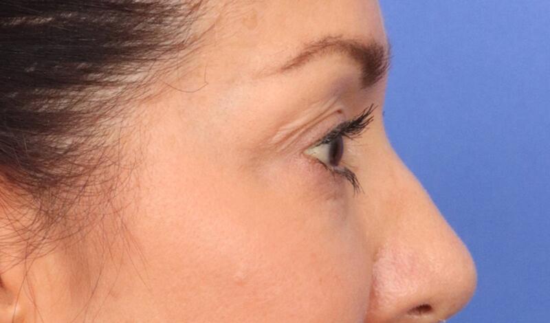 Eyelid Surgery Before & After Image