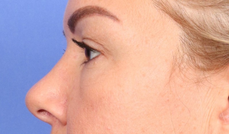Eyelid surgery Before & After Image
