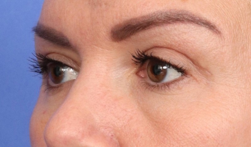 Eyelid Surgery Before & After Image