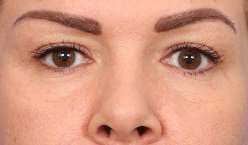 Eyelid Surgery Before & After Image