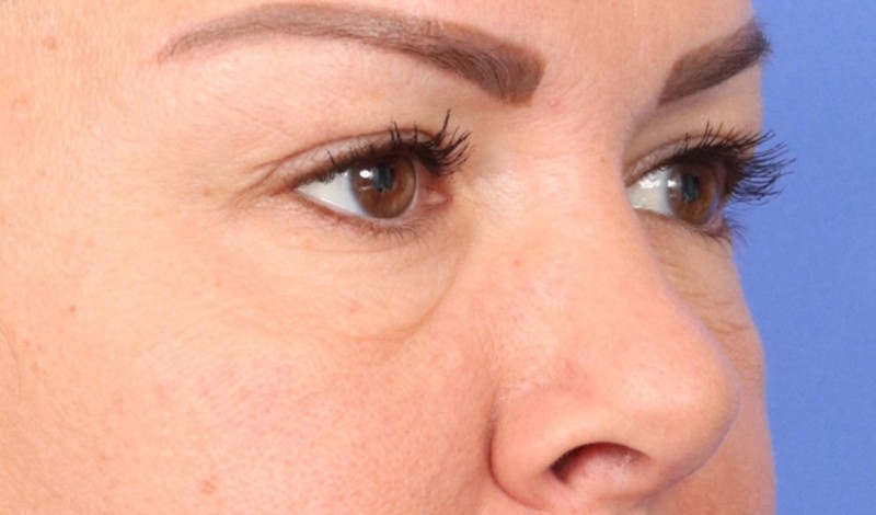 Eyelid Surgery Before & After Image