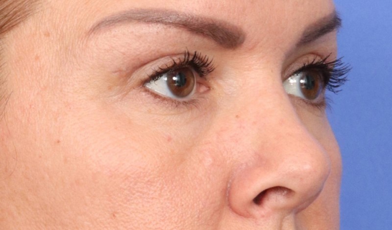 Eyelid Surgery Before & After Image
