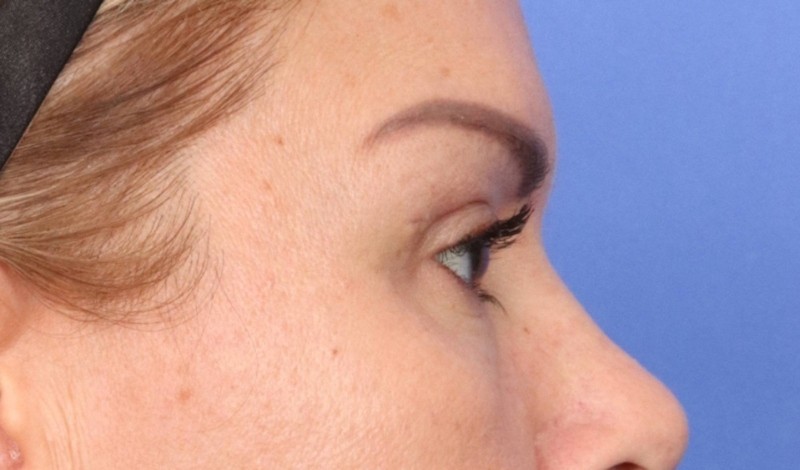 Eyelid Surgery Before & After Image