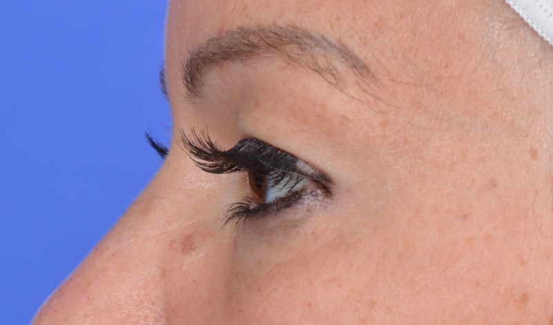 Eyelid surgery Before & After Image