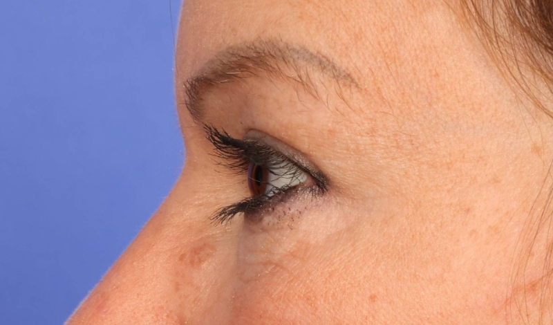 Eyelid surgery Before & After Image