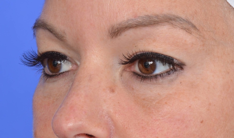 Eyelid Surgery Before & After Image
