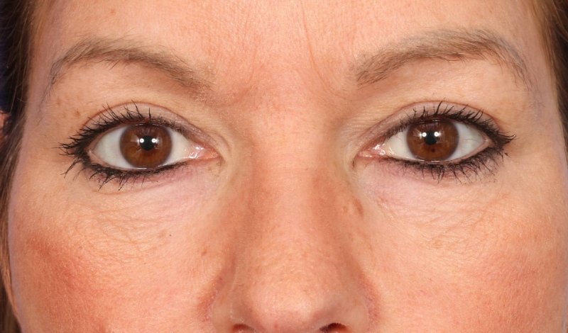 Eyelid Surgery Before & After Image