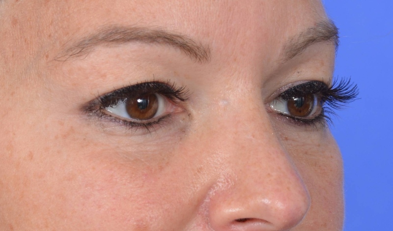 Eyelid Surgery Before & After Image