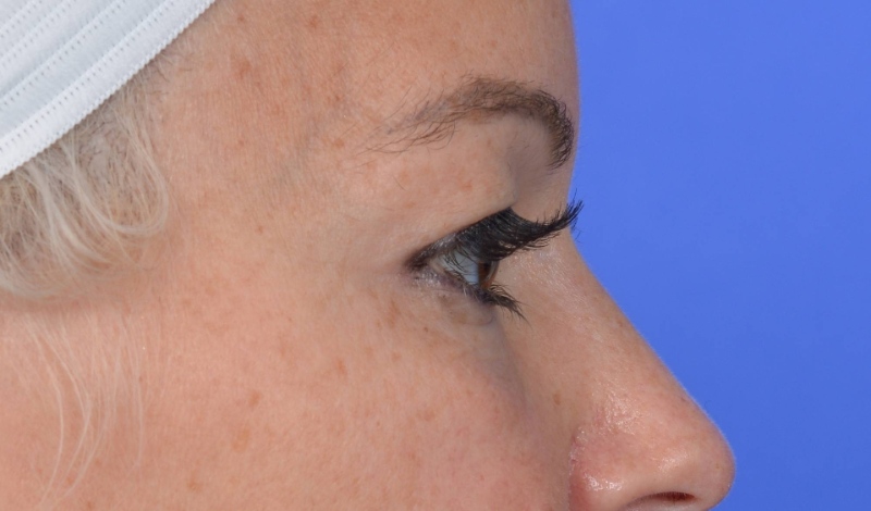 Eyelid Surgery Before & After Image