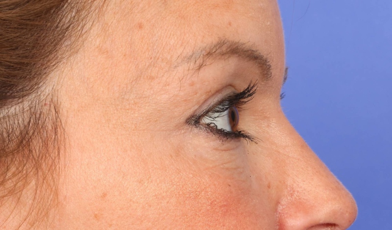 Eyelid Surgery Before & After Image