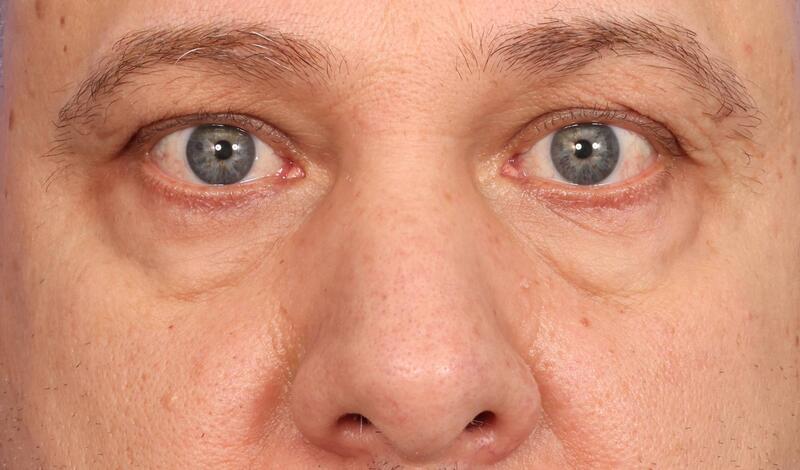 Eyelid Surgery Before & After Image