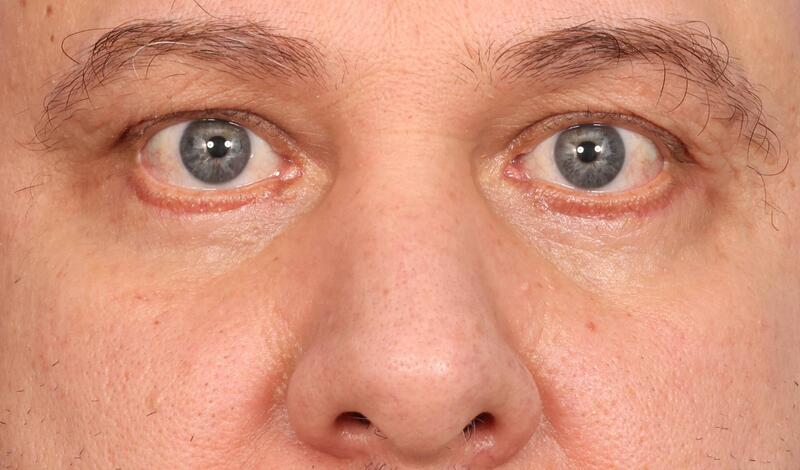 Eyelid Surgery Before & After Image