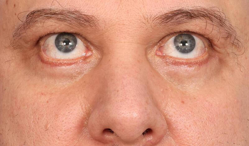 Eyelid Surgery Before & After Image
