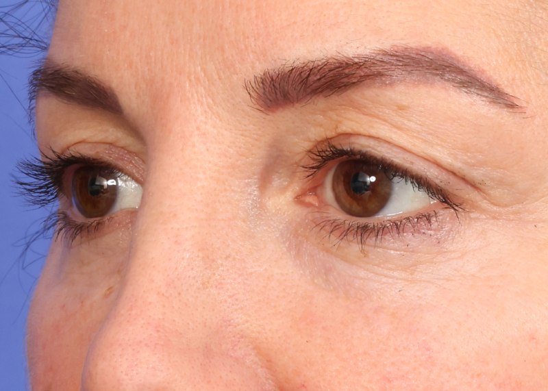 Eyelid Surgery Before & After Image