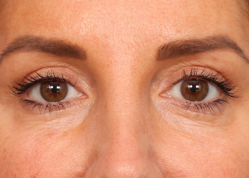 Eyelid Surgery Before & After Image