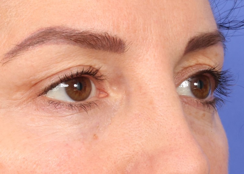 Eyelid Surgery Before & After Image