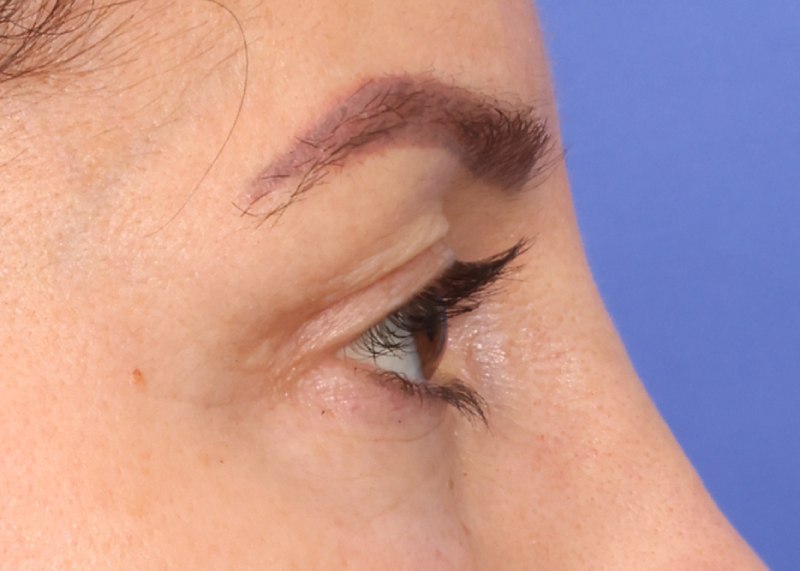 Eyelid Surgery Before & After Image