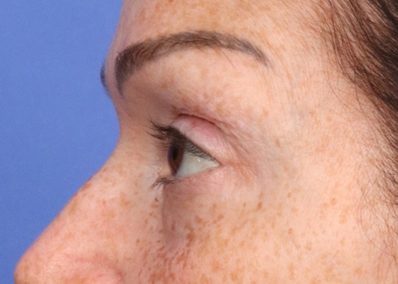 Eyelid surgery Before & After Image