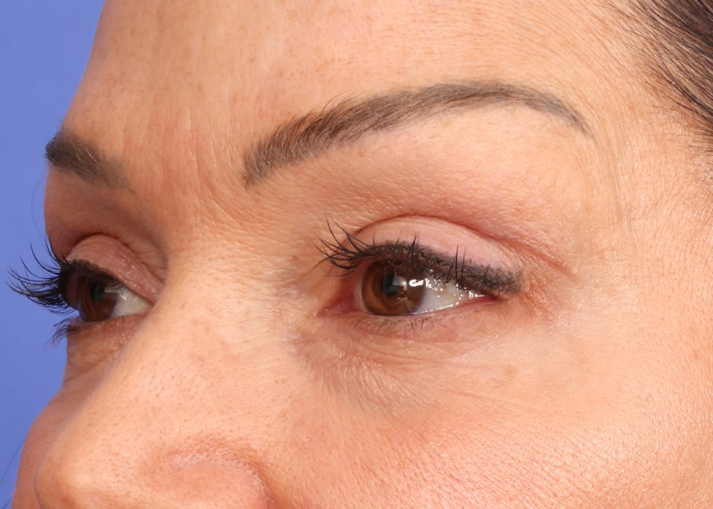 Eyelid Surgery Before & After Image