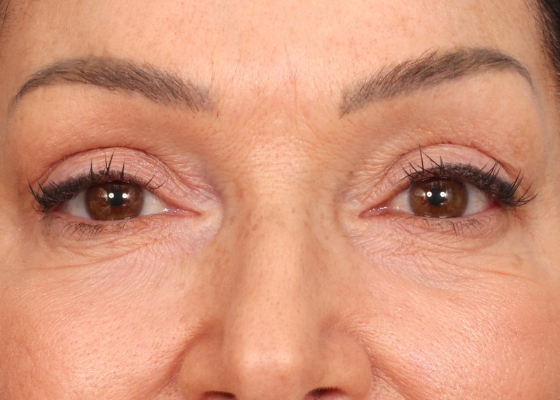 Eyelid Surgery Before & After Image