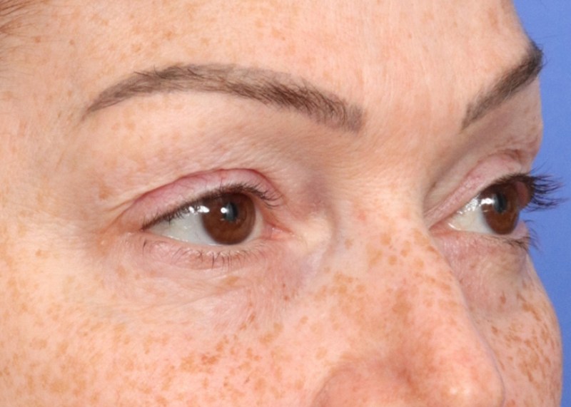Eyelid Surgery Before & After Image