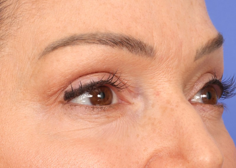 Eyelid Surgery Before & After Image