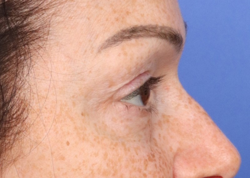 Eyelid Surgery Before & After Image