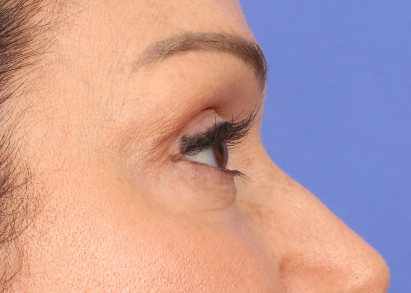 Eyelid Surgery Before & After Image