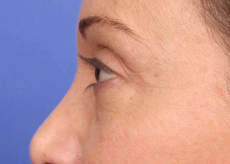 Eyelid Surgery Before & After Image