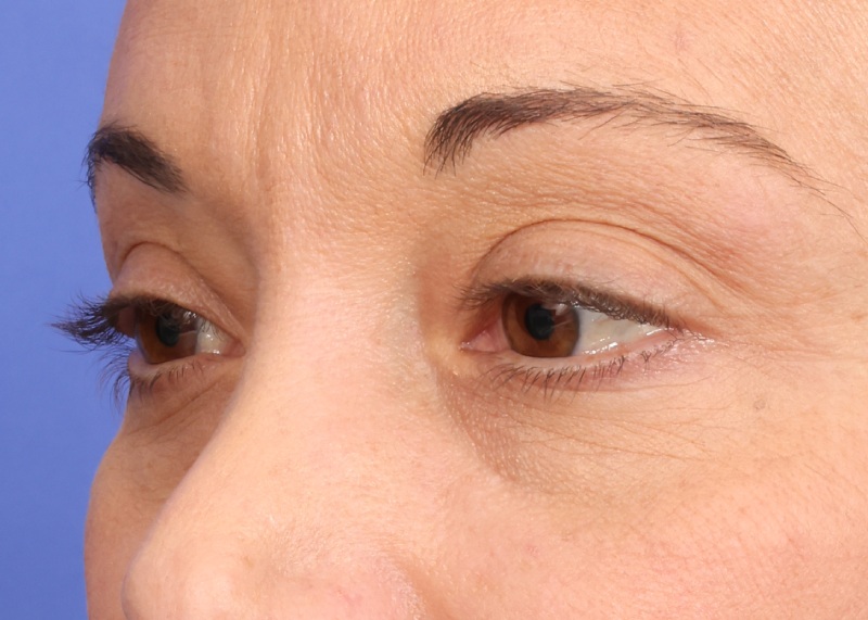 Eyelid Surgery Before & After Image